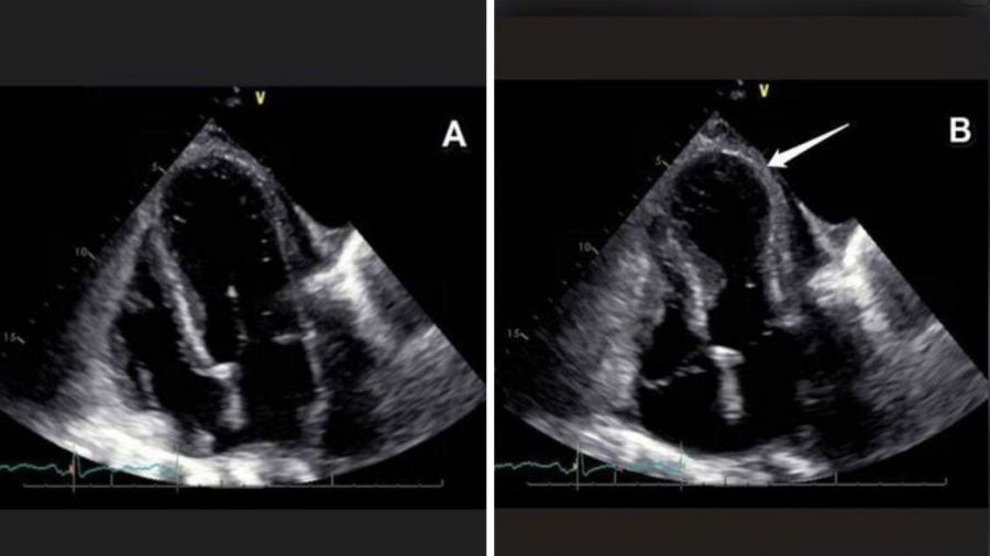 القلب يتأثر بالمشاعر: كيف يمكن للحب والحزن أن يؤثّرا فعليًا على صحة القلب؟